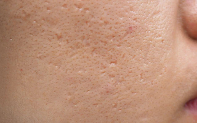 Ice pick acne scars on face treated