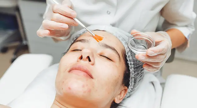 chemical peel treatment on face for acne and skin concerns